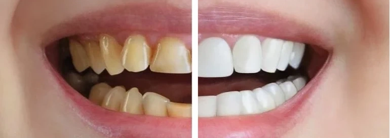 Dental crowns before and after at Whitehaven Dental Ottawa